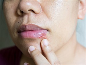 shutterstock_1938352927_herpes_herpes vīruss.jpg