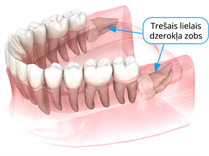 YCUZD_230823_5481_trešais lielais dzerokļa zobs_3.png