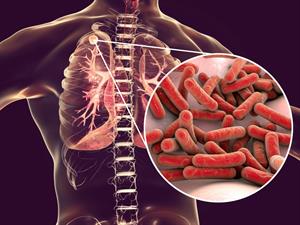 Shutterstock_1065839408_tuberculosis in lungs_tuberkuloze plaušās.jpg