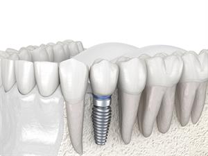 shutterstock_1648436755_premolar tooth_premolārs_zobs.jpg