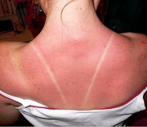 sunburn.jpg