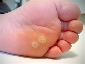 shutterstock_1041891454_warts_kārpas.jpg