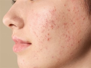 shutterstock_1593164065_acne_akne.jpg