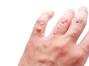 shutterstock_2252481433_warts_kārpas.jpg
