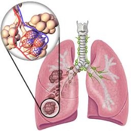 emphysema-lung.jpg