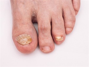 shutterstock_2414885943_nail fungus_nagu sēnīte.jpg