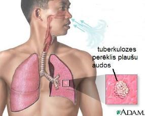 tuberculosis-of-the-lungss.jpg