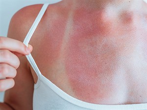 shutterstock_2318494517_sunburn_apdegums.jpg