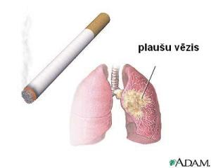 lung_cancert.JPG
