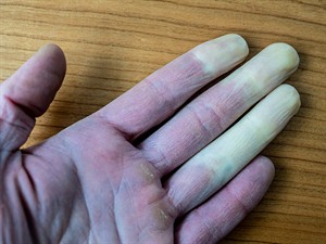 shutterstock_2119977311_frostbite_apsaldējums.jpg