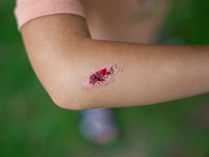 shutterstock_2501025281_wound_brūce.jpg