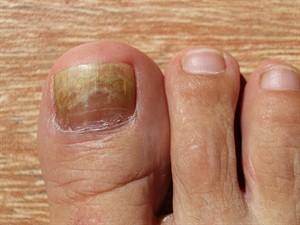 shutterstock_2058276512_nail fungus_nagu sēnīte.jpg